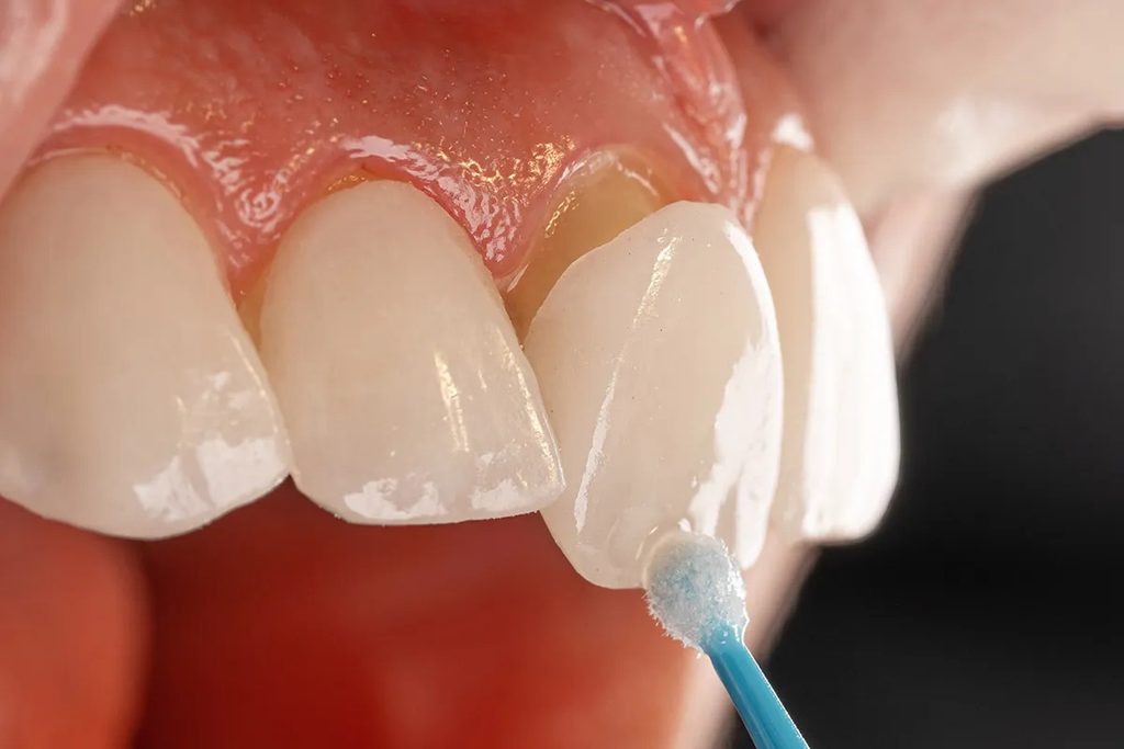Veneers near me